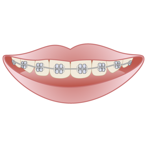 小児矯正 - 富山の小児歯科・小児矯正専門！歯並びだけでなく全身の